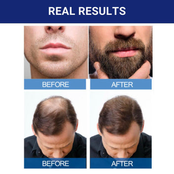 Minoxidil 5% Extra Strength Hair Regrowth Topical Solution Treatment - a 12-month supply in drops.